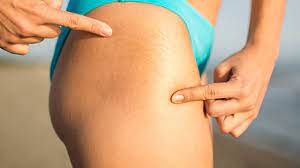 How To Get Rid Of Stretch Marks As Fast As Possible Top 10 Home Remedies