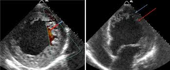 Image result for Left Ventricular Noncompaction