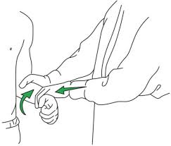 Image result for Yergason Test