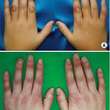 This pain tends to occur on both sides of the body at the same time, particularly in the joints of the wrists, hands, fingers, and knees. Pdf Childhood Chilblain Lupus Erythematosus