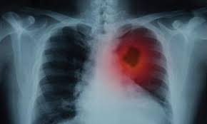 Your guide to the different types of mesothelioma and how this helps your doctor decide which treatment you need. Ai To Help Fight Asbestos Related Cancer Healthcare In Europe Com