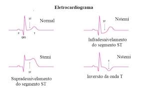 Diferentes ondas de ecg de um enfarte do miocárdio xl. Infarto Agudo Do Miocardio O Que E Fisiopatologia E Tipos