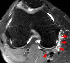 The gastrocnemius (also gastrocnemius muscle, latin: Proximal Gastrocnemius Tendon Pathology Radsource