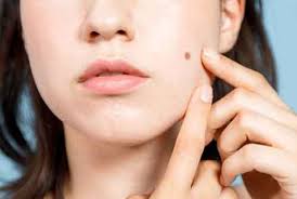 Menghilangkan jerawat batu yang efektif umumnya dengan menggunakan obat jerawat dan bantuan dokter kulit atau ahli dermatologis. Cara Menghilangkan Jerawat Dengan Mudah Dan Alami