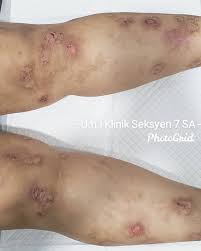 Image result for Neurodermatitis