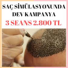 Sac Simulasyonunda Dev Kampanya 3 Seans Sac Simulasyonu Sabit Fiyat 2800 Tl Detayli Bilgi Ve Randevu Icin Hemen Arayin Saglikli Sac Sac Sac Dokulmesi