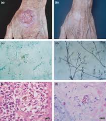 Fonsecaea pedrosoi and the recently described f. Chromoblastomycosis Caused By Fonsecaea Clinicopathology Susceptibility And Molecular Identification Of Seven Consecutive Cases In Southern China Clinical Microbiology And Infection