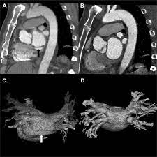 128 Slice Ct Scanner Vs 64 Slice Ct Scan Machine