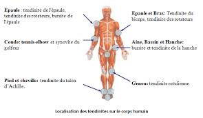 La tendinite est une inflammation des tendons, ces cordons qui relient les muscles aux os. La Tendinite Tms Des Membres Superieurs Neholys