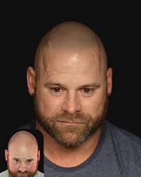 Profile for Scalp micropigmentation by Alex Corona