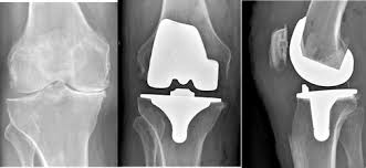 Maybe you would like to learn more about one of these? From Arthrosis To Knee Prosthesis Docteur Remi Co Uk