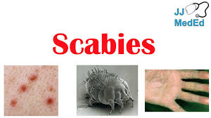 Image result for what does scabie look like