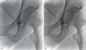 Image result for Pudendal Block