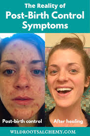 Post Birth Control Acne In 2020 Birth Control Acne Birth Control Stopping Birth Control