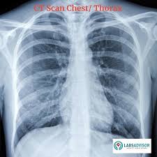 There are two types of heart ct most commonly used; 50 Off On Ct Scan Cost In India From 1200 Only