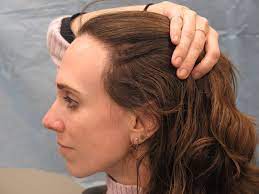 I Hated My Hairline So I Got A New One Hairstyles For Receding Hairline Bad Hairline Widows Peak Hairstyles