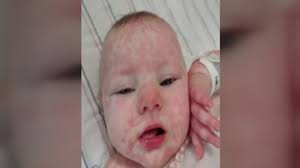 Louisville mother warning other parents of Kawasaki Disease in Kentucky