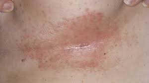 Image result for heat rash under breasts