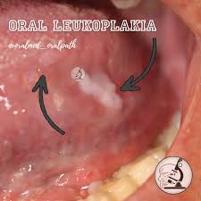 Image result for Sublingual Varices