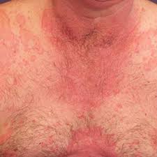 Symptoms of anaphylaxis come on suddenly and can include hives, vomiting, swelling of the tongue, face, or throat, difficulty. 11 Pictures Of Anaphylaxis Symptoms