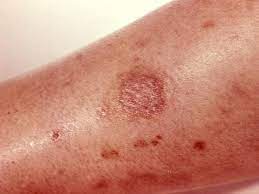 If you think or know your child has been bitten by a venomous spider, treat it. Signs Of A Spider Bite
