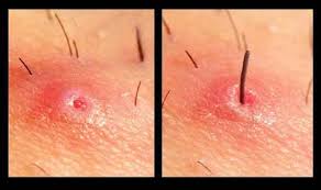 Finde den passenden reim für „poil du pubis ▶ ähnliche wörter zum gesuchten reim 153.212 wörter online ständig aktualisierte reime reime in 13.de was reimt sich mit poil du pubis? 5 Remedes Qui Marchent Pour Se Debarrasser Des Poils Incarnes