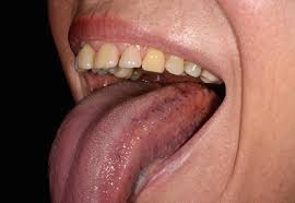 Pickel auf der zunge entstehen aus unterschiedlichen gründen. Erkrankungen Der Lippen Und Der Mundhohle Springerlink