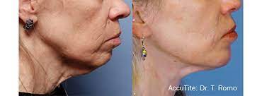 Essentially, embracerf is a combination of two technologies that offer a versatility for surgeons that they have never had before. Face Neck Contouring And Skin Remodeling Embracerf