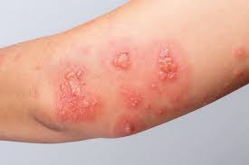 Image result for shingles in children