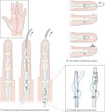 Flexor tendon injury is among the most common cases represent to the er, and it's usually due to volar lacerations. Single Stage Free Tendon Grafting For Flexor Tendon Injury In Fingers Plastic Surgery Key