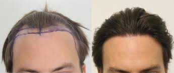 The clinic is immaculate and clean.i am very pleased with the level of care i received. Considering A Fue Hair Transplant In Los Angeles Read This