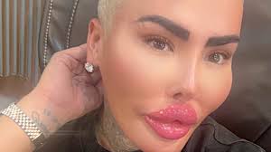 Revealed: Mother, 33, who died after non-surgical BBL was treated at UK  beauty clinic run by TV star dubbed the 'Lip King'