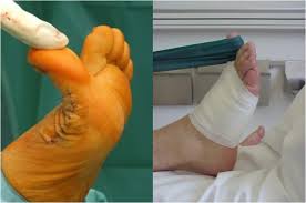 Neben der verformung sind schmerzen, beeinträchtigung der nachbarzehen mit. Vorfuss Hallux Valgus Hallux Rigidus Kleinzehenfehlstellung Grosstes Kommunales Krankenhaus In Nrw