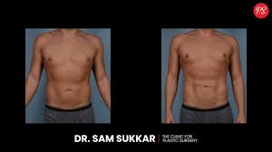 Image result for Liposuction