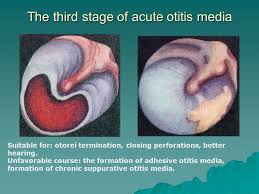 Acute otitis media is usually a complication of eustachian tube dysfunction that occurs during a viral upper respiratory tract infection. Acute And Chronic Inflammatory Diseases Of The Outer And Middle Ear The Role Of Occupational Factors In The Occurrence Of Diseases Of External Ear The Ppt Download