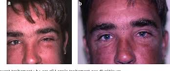 A., qureshi t., ali s., ayub b. Efficacite Des Diuretiques Dans La Prise En Charge Therapeutique De La Maladie De Morbihan Trois Cas Semantic Scholar