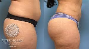 However, the cost can range from $2,300 to $10,800. Brazilian Butt Lift And Social Media Petrungaro Plastic Surgery