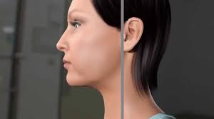Capital Skin, Double Chin, Chin Lift, Clifton Park, Saratoga, Albany,  Latham, Schenectady