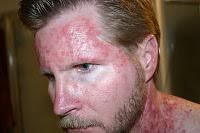 Another Efudex Experience (article) by Fritz Barnes