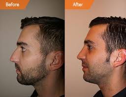 More men get botox than any other procedure. Plastic Surgery For Men New York Male Plastic Surgery Nyc