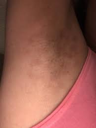 This is largely attributed to the. Laser Hair Removal Dark Spots Underarms Photos