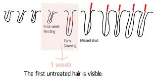 There is a 30% rise to those who undergo laser hair removal. Does Hair Regrow After Electrolysis Hair Removal 2pass Clinic