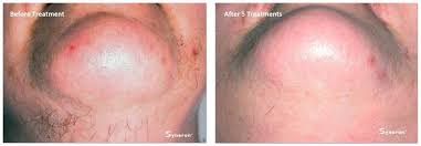 This process is usually fast (depending on the area being treated). Laser Hair Removal Permanent Hair Removal Aesthetic Laser Services Jefferson City Missouri
