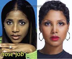 Toni braxton plastic surgery is no longer a mystery. Toni Braxton Plastic Surgery Before And After Nose Job Rhinoplasty Nose Jobs Plastic Surgery