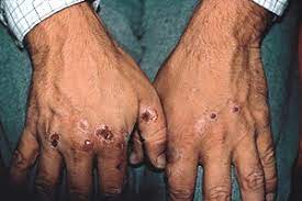 Kidney Disease 11 Ways It Can Affect Your Skin