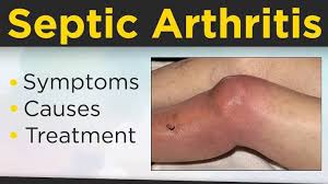 Image result for Septic Joint