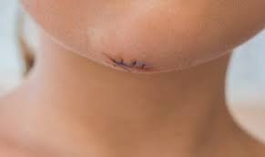 Or the doctor may need to remove the stitches in about 3 to 5 days. Do I Need Stitches 10 Signs You Need To Go To The Er Village Ec