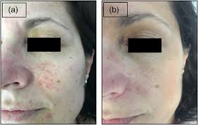 Image result for demodex rosacea