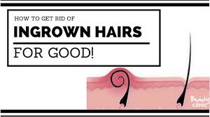 how to get rid of ingrown hairs