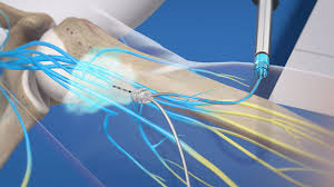 Image result for Axillary Nerve Block